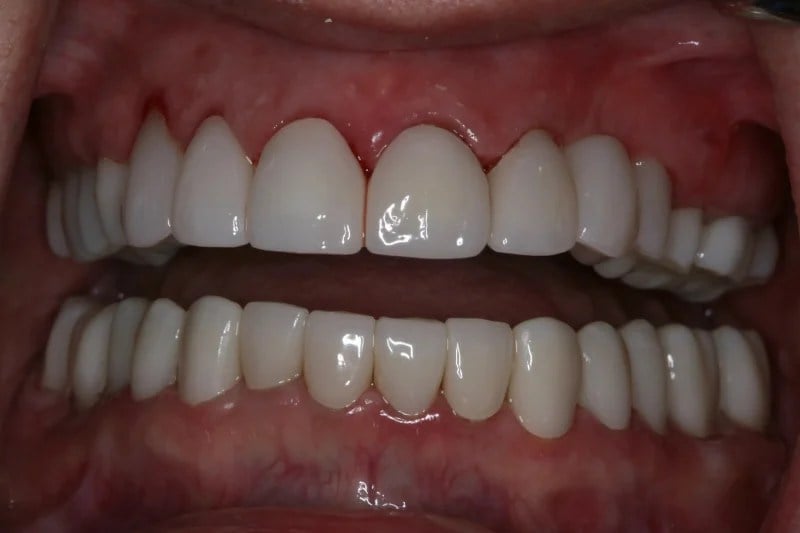 Before and after